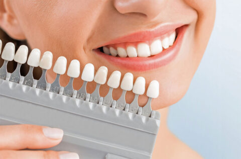 A lady is checking the shade of her teeth with a tooth shade guide