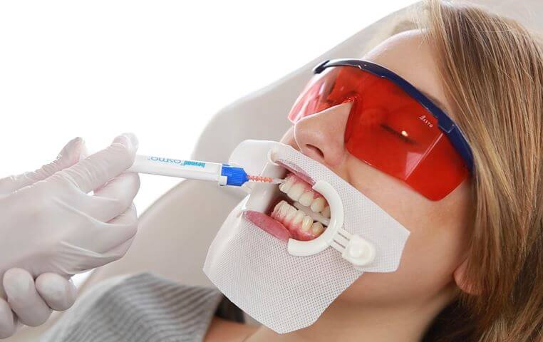 how to apply whitening gel